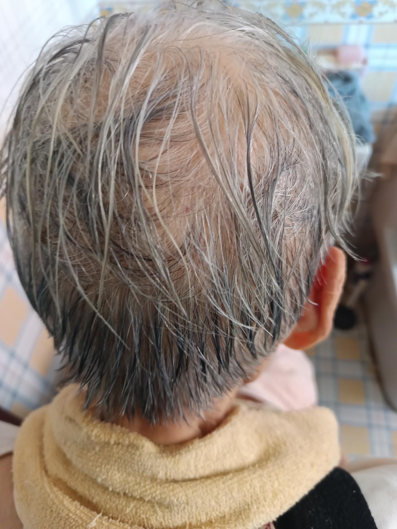 看看我妈，89岁老太太，头后边黑发比我都多[大笑][大笑]
我是30多岁就开始有