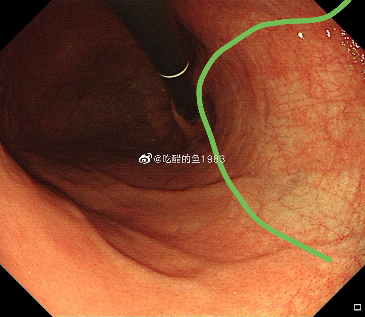 萎缩是很容易在内镜下区分的，白色的那些都是萎缩后的黏膜，所以这就是木村分类的C-