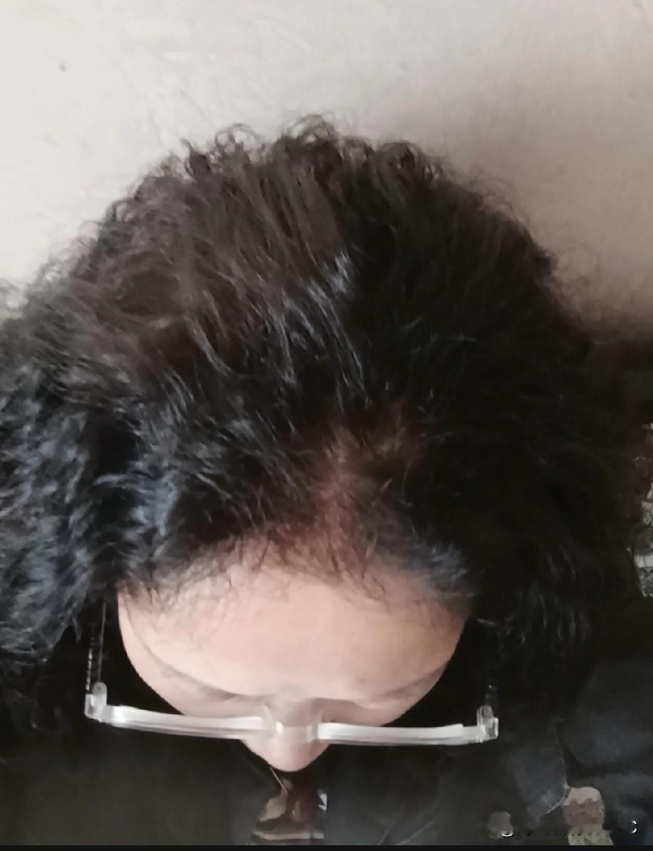 60多岁了，这个发量还可以吧！头发黑了，感觉人也看着年轻了。
头发花白，多少年没