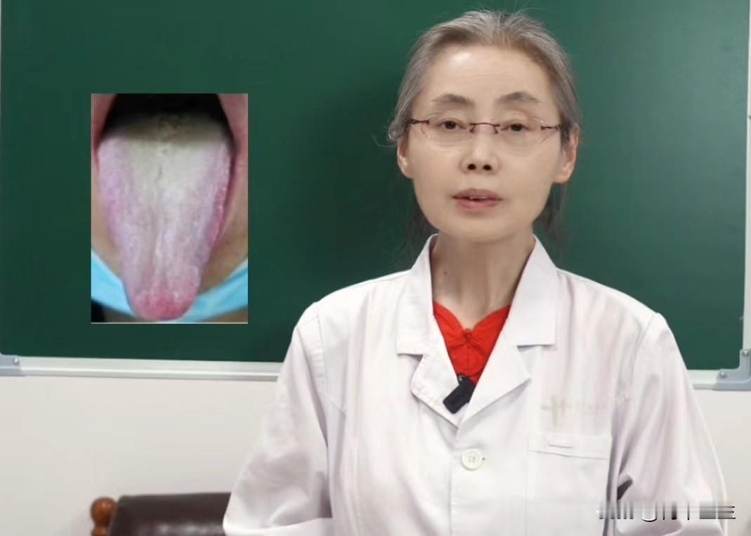这种黄腻苔，只清火不温阳，方向不对努力全废!

这位粉丝朋友主诉:怕冷，口干口苦