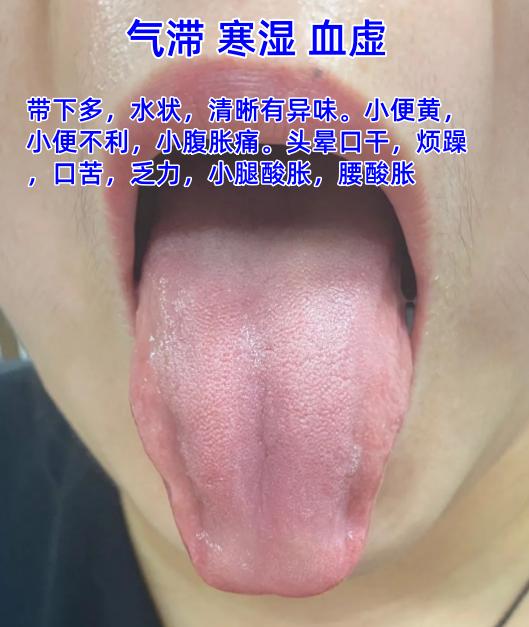 这会不忙，抽空来帮大家继续分析舌象

你早发，我早看

1.气滞 寒湿 血虚
带