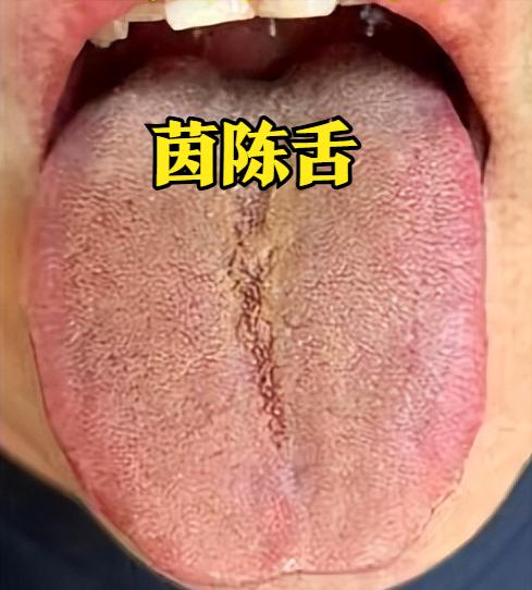 一、舌象辨证：跳出 “脾虚” 误区，认准 “肝火 + 湿热” 信号
很多人出现消