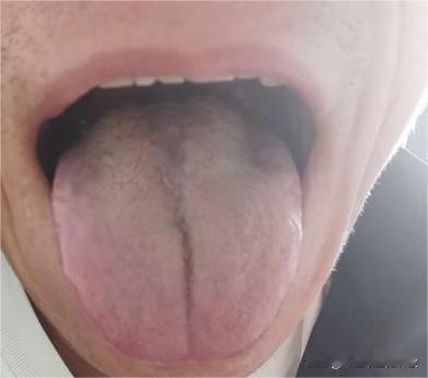 你这舌苔都厚成蒙古包了，亏虚成啥样了，还晕着头呢[尬笑][尬笑]
大哥都43了，