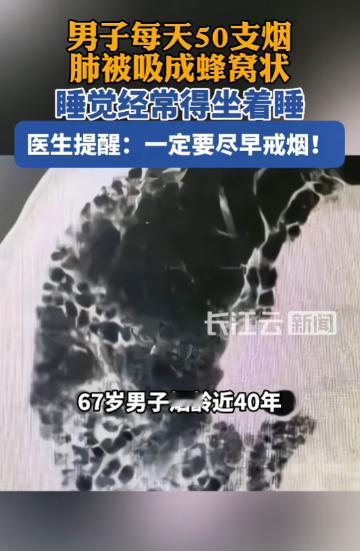 河南，67岁男子烟龄近40年，每天雷打不动50支烟，长期胸闷咳嗽，爬二楼楼梯都受