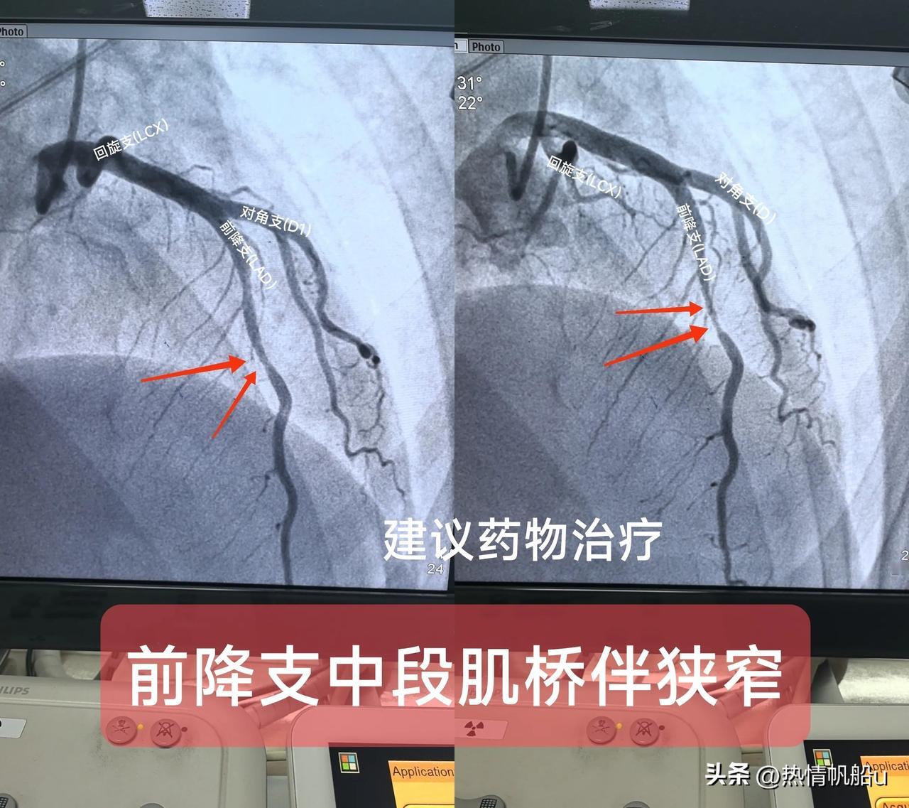 冠状动脉心肌桥
（前降支中段肌桥伴狭窄）
一.概念：
冠状动脉正常走行于心外膜下