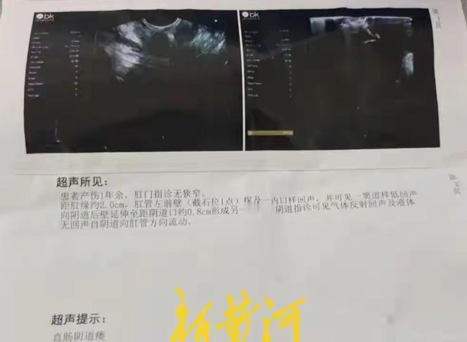 有时候人心比手术刀还寒！河北任丘，一位新手妈妈剖腹产三天后，竟然从阴道排出了大便