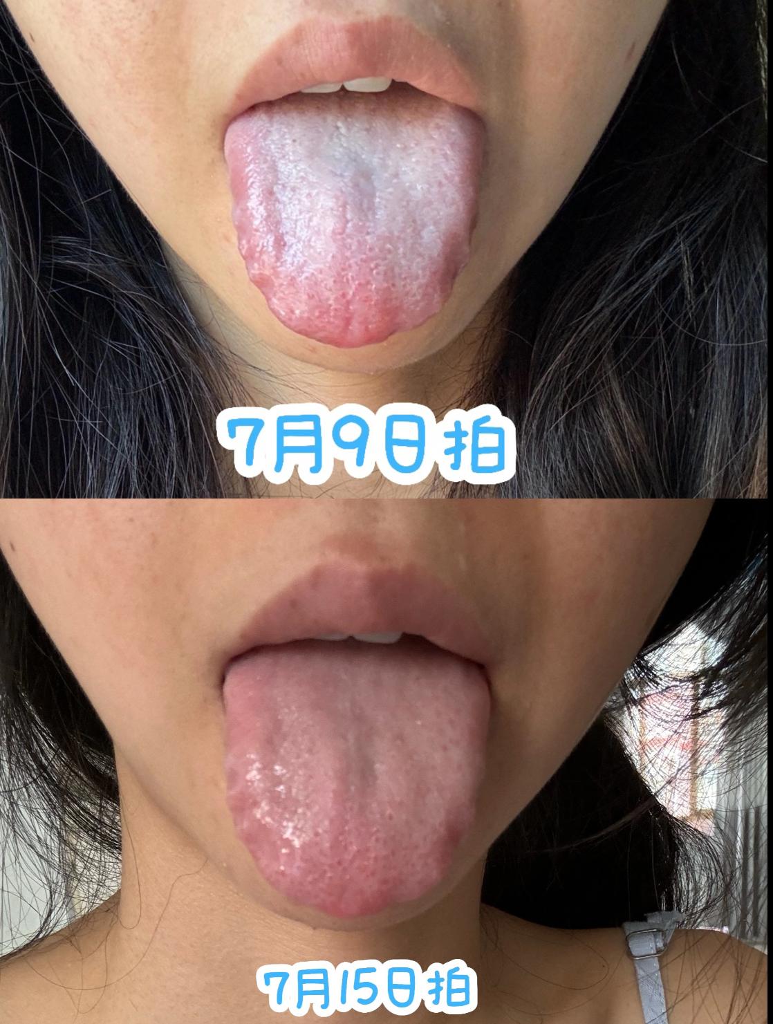 听话就能好！健脾祛湿之前，先看看有没有舌苔
这一位病友就很遵医嘱，脾虚湿气重，夹