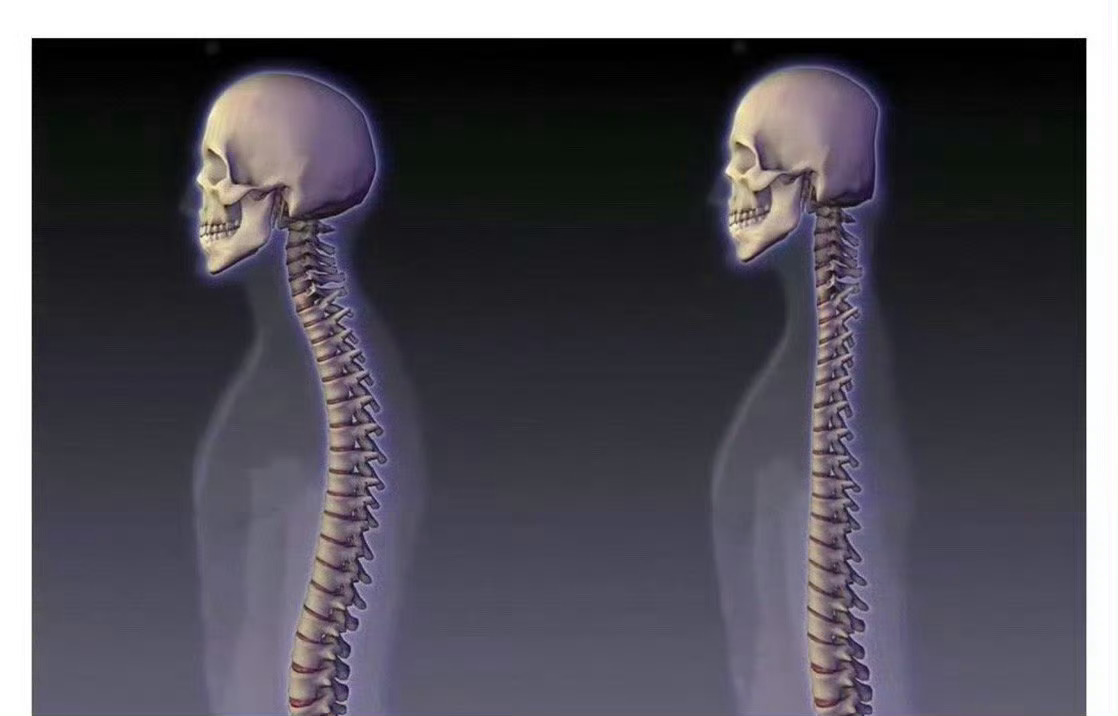 #刘宇宁 脖子前倾#左边是正常人 右边是“僵尸” 大家别太大压力，别太卷 ​​​