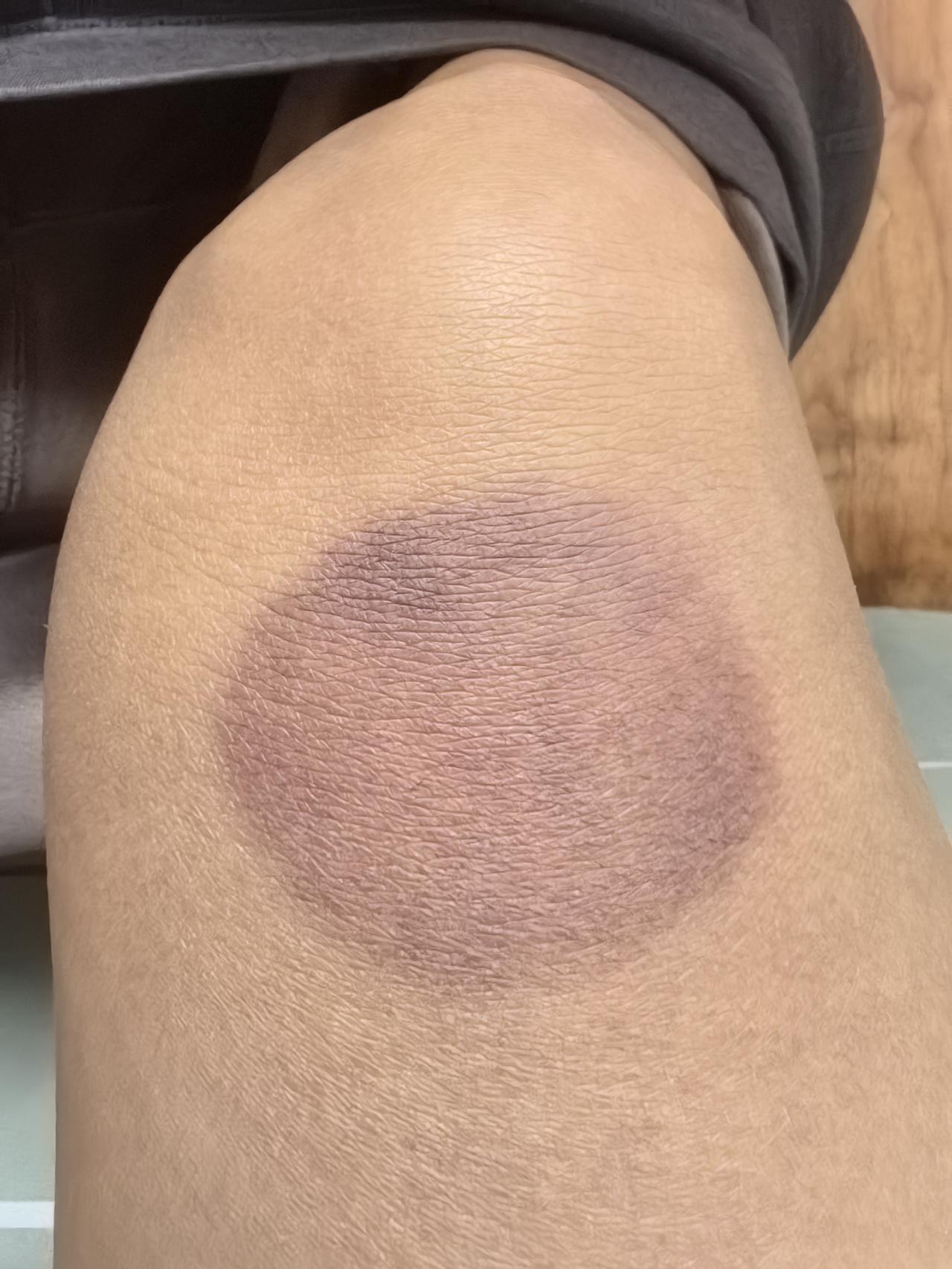 好多天了膝盖疼，吃止疼药，拍片让少运动歇几天。咋天晚上有受不住疼就翻出一个久不用