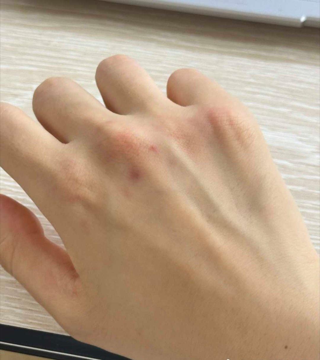 2155【莪的抗压能力】by bike：只是跟老师谈话20分钟我的手就被自己掐成