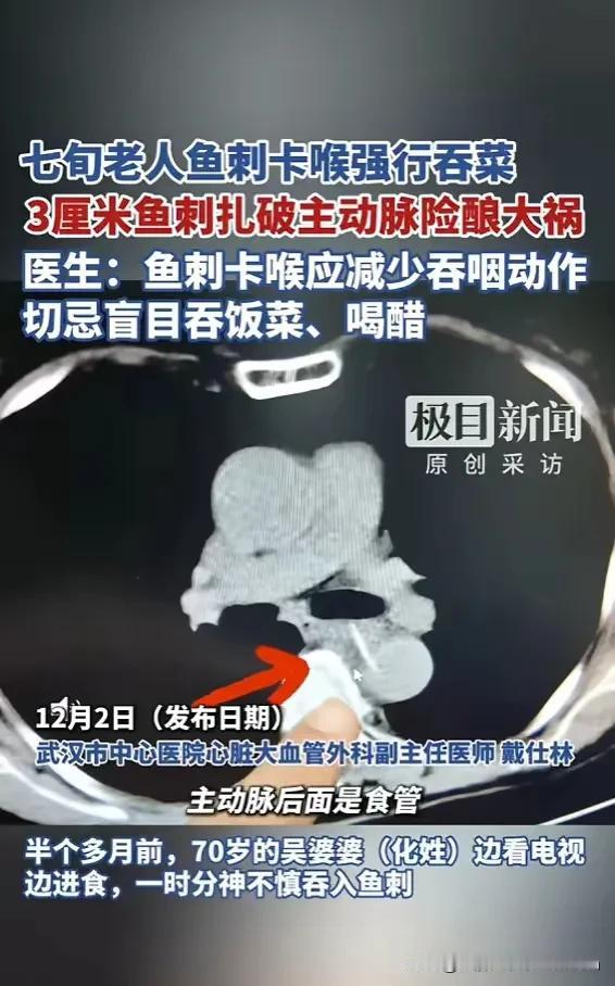 险！老太鱼刺卡喉吞菜强咽，5天后刺破主动脉

盲目土方法酿成大祸，医生紧急提醒。