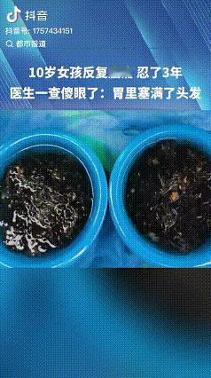 “爱吃头发？”

近日，福建福州一名10岁的小女孩，肚子反反复复的疼痛，据说，这