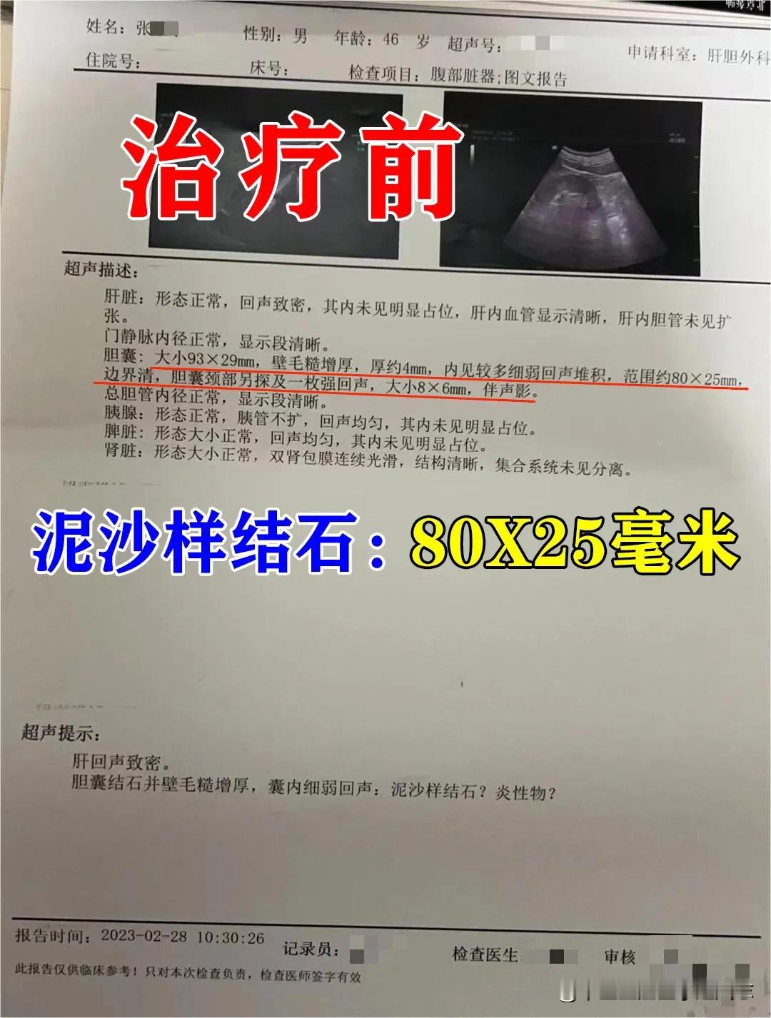 王先生，胆囊大小93*29mm，壁毛糙增厚，厚约4mm，内见较多细弱回声堆积，范