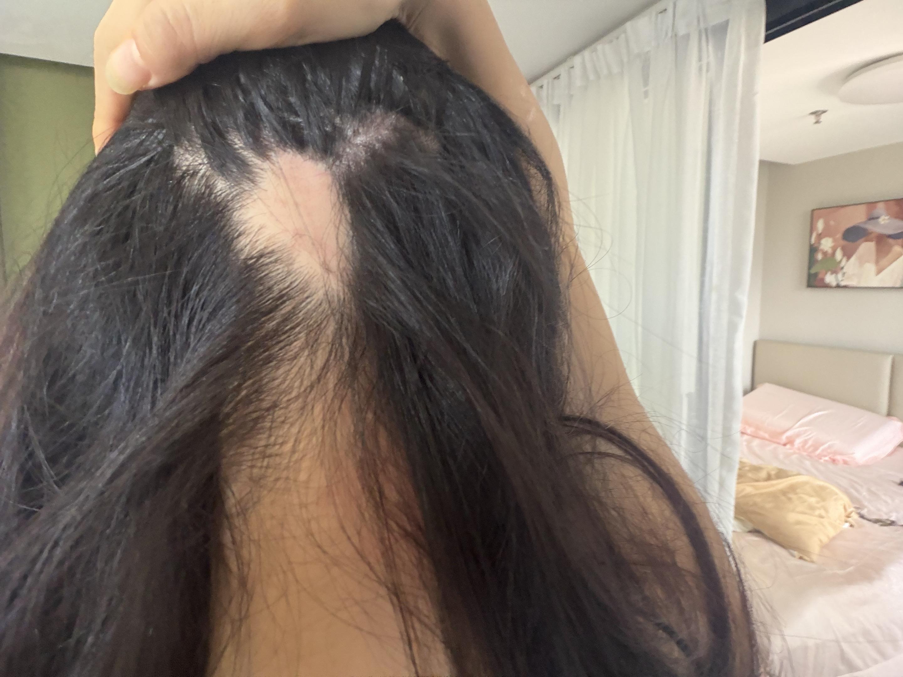 笑死 因为焦虑斑秃掉发 又因为斑秃掉发焦虑
