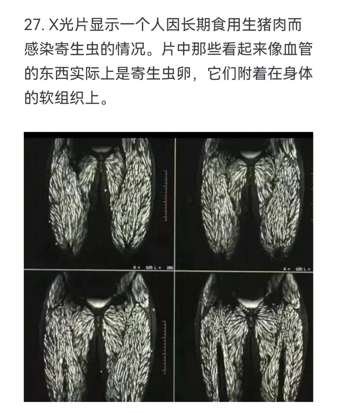 X光片显示一个人因长期食用生猪肉而感染寄生虫的情况