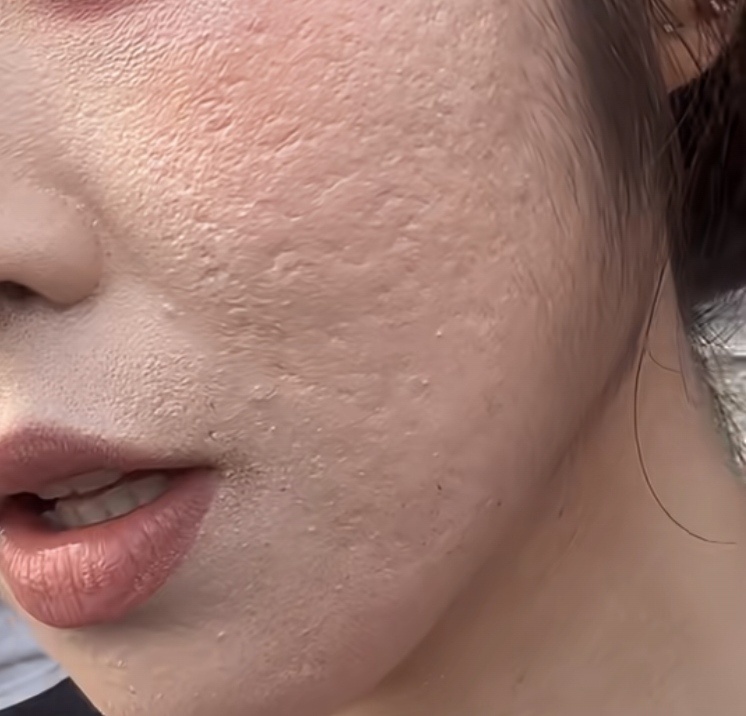 橘皮或者痘坑的人，我都会第一时间关注他们的耳朵。你就是你自己吃出来的，按照我分享
