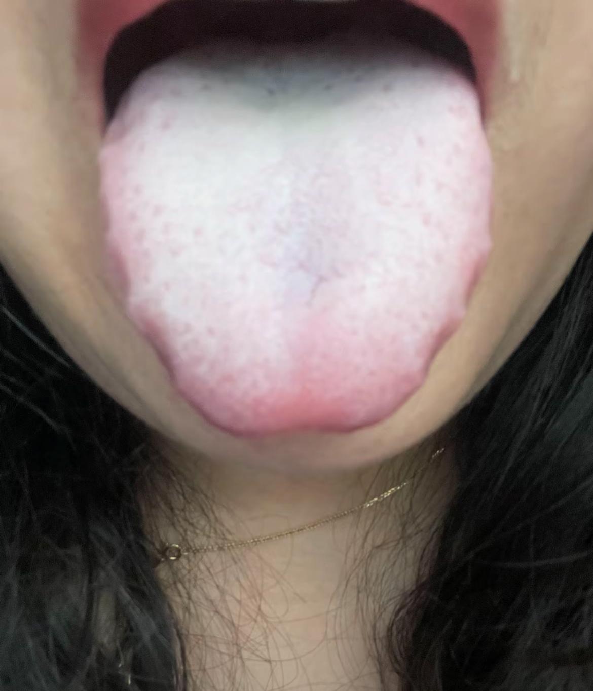 舌头惨白惨白的，没有一点血色，像白雪糕似的
你可不光是气血不足！看到这种舌象，我