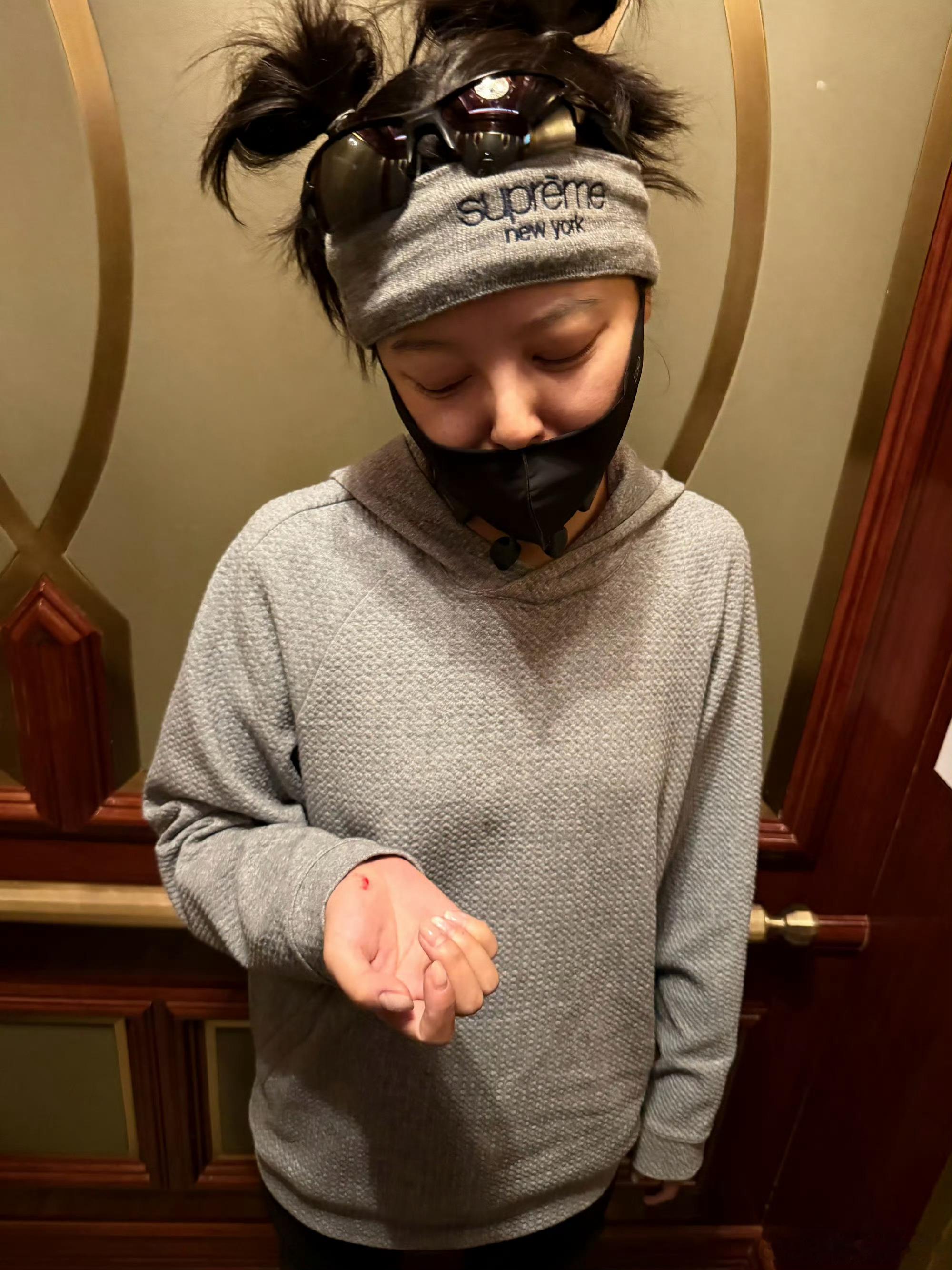 辛芷蕾骑车又摔了四肢全费辛芷蕾昨晚发文自曝骑车摔了，腿和手都破了
