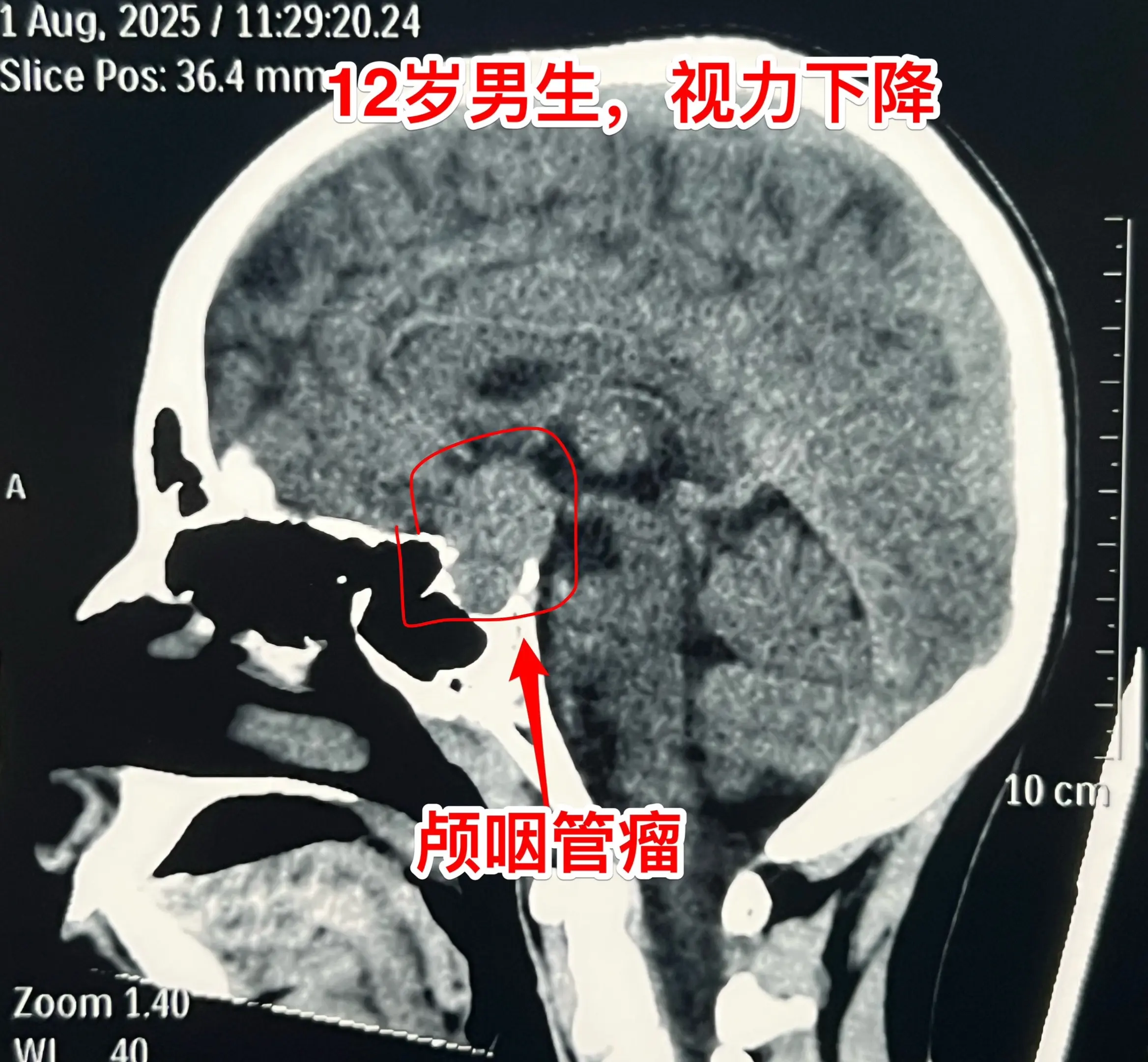 12岁男孩子，视力差、身高增长缓慢。12岁男孩子，视力下降、身高增长缓...