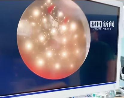 “悲剧还是发生了！”10月30日报道，湖北武汉，一17岁少年因好奇，将85颗磁珠