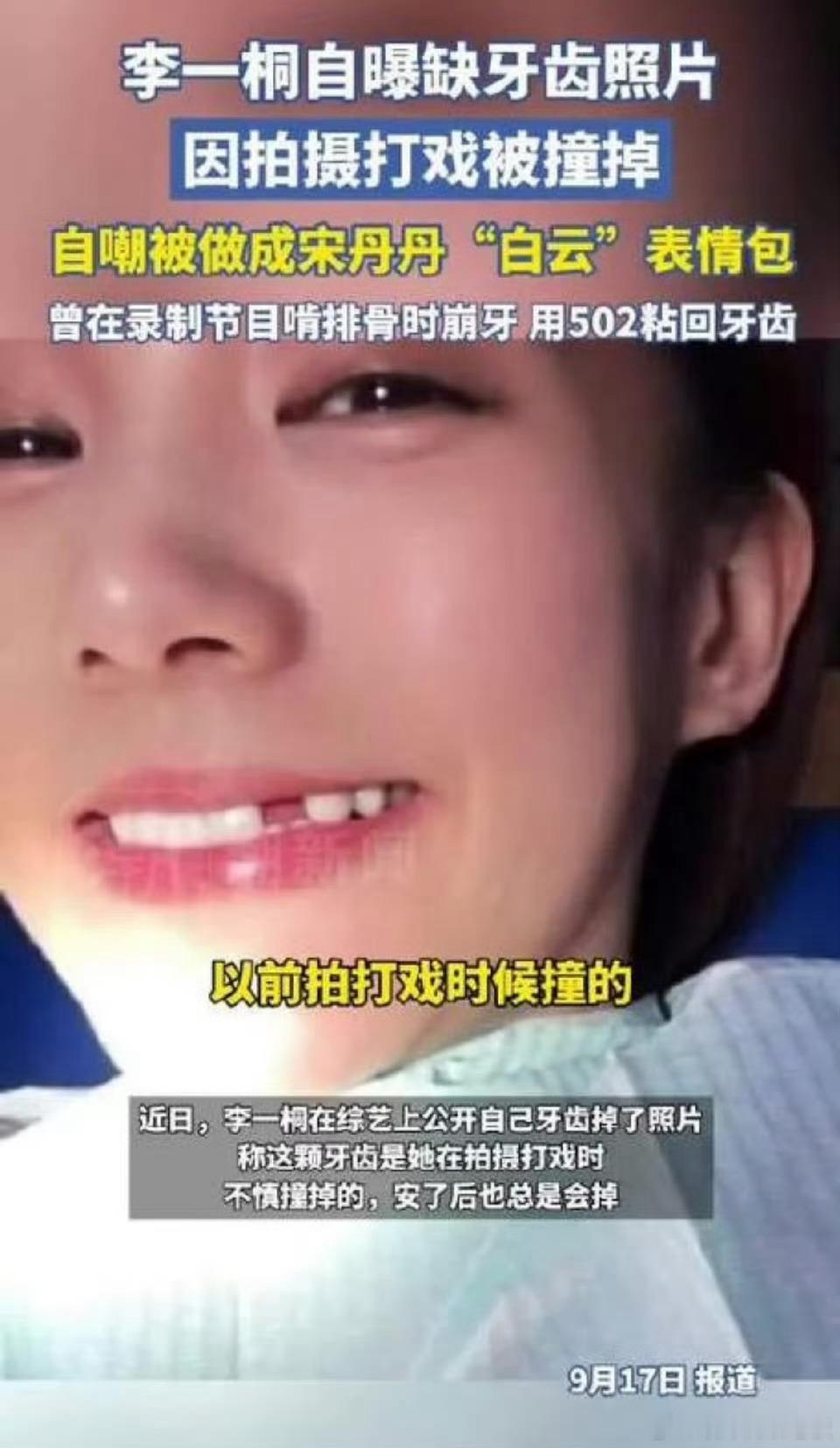李一桐被磕掉了一颗牙 李一桐这波自曝也太圈粉了！拍戏把牙崩了不仅不藏着掖着，还直