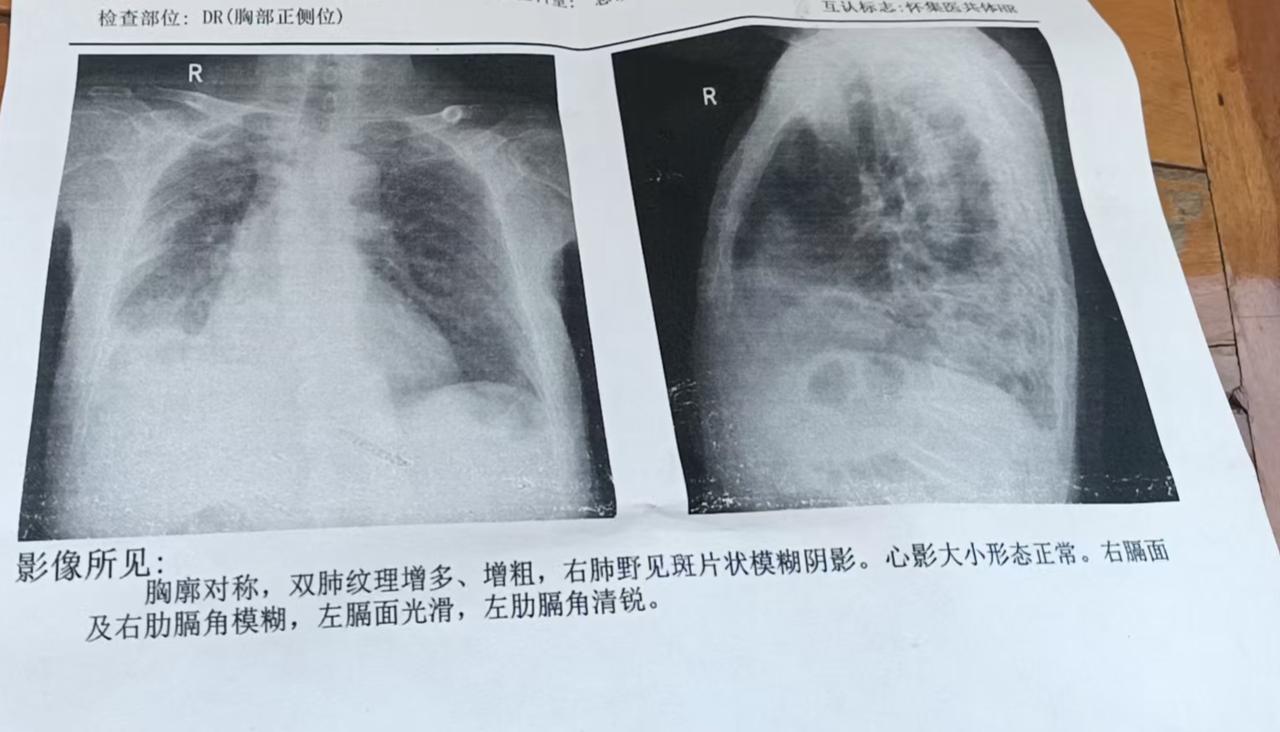 肺部一半都白了，有没有办法治疗好、那里有好的医院 求大家告诉我一下，我要崩坏了