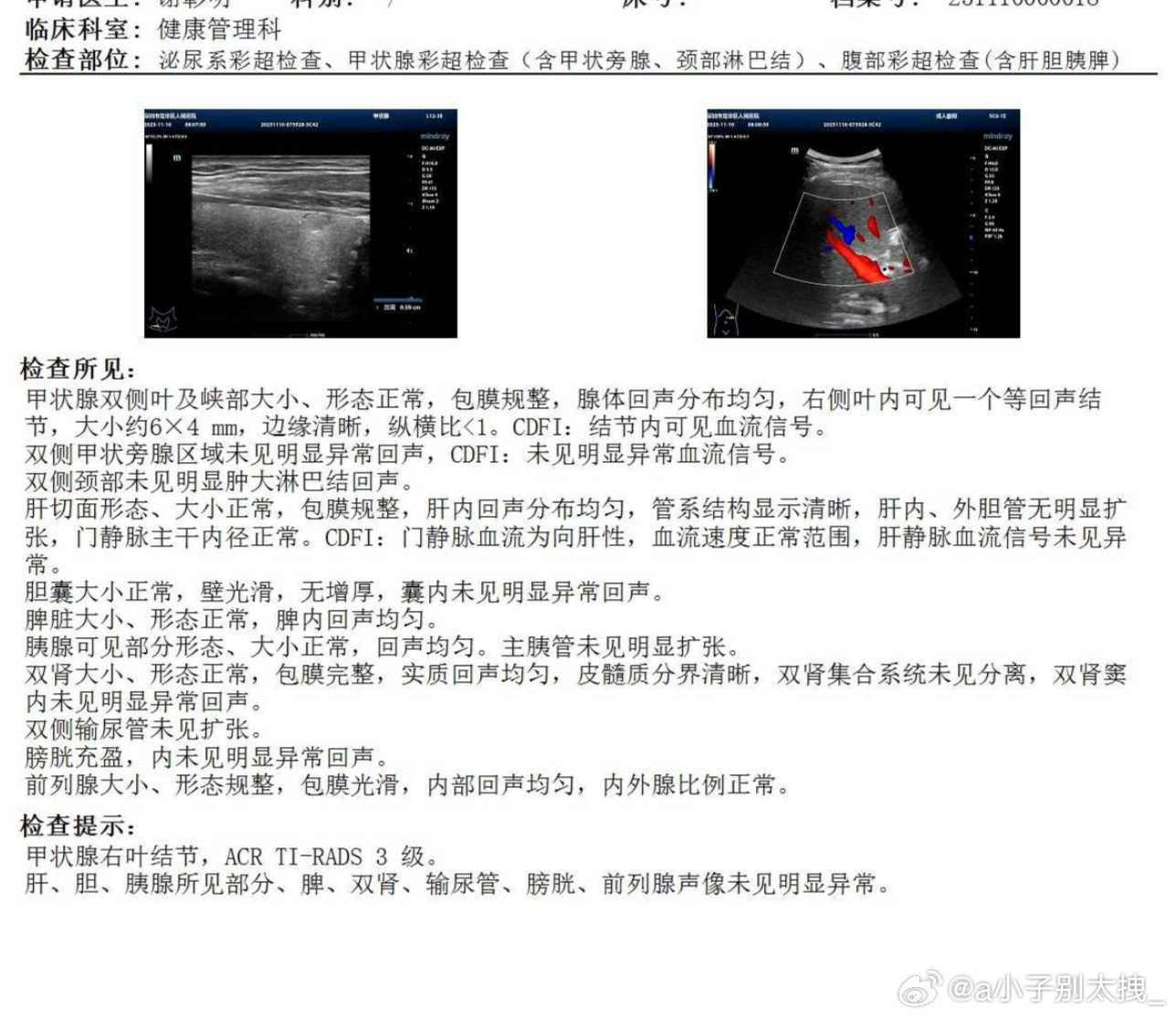甲状腺癌为何越来越多这个能自主消掉嘛！ ​​​