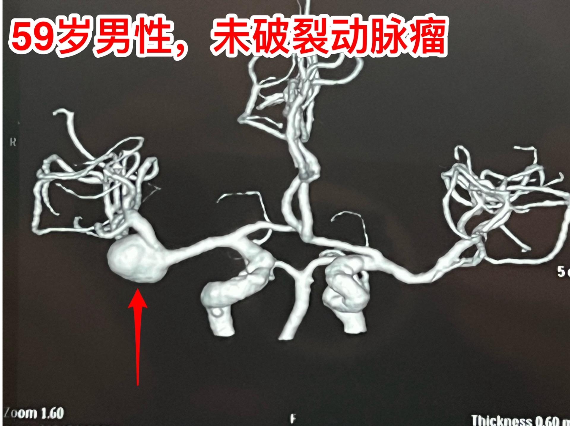 发现未破裂的脑动脉瘤就要作手术吗？慎重！40岁以上的人群中作CTA或者...