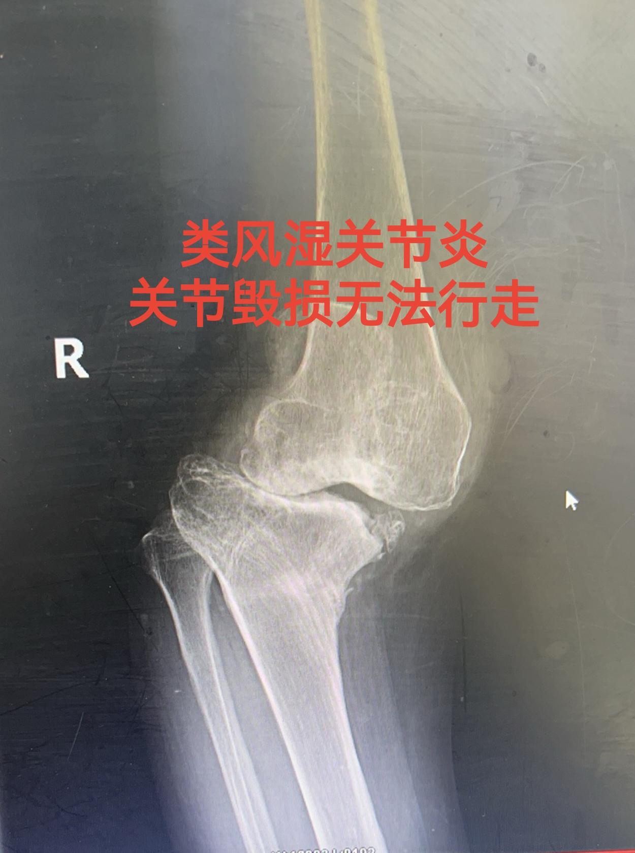 类风湿关节炎。类风湿关节炎，关节毁损，无法行走。备的CCK和铰链膝，最...