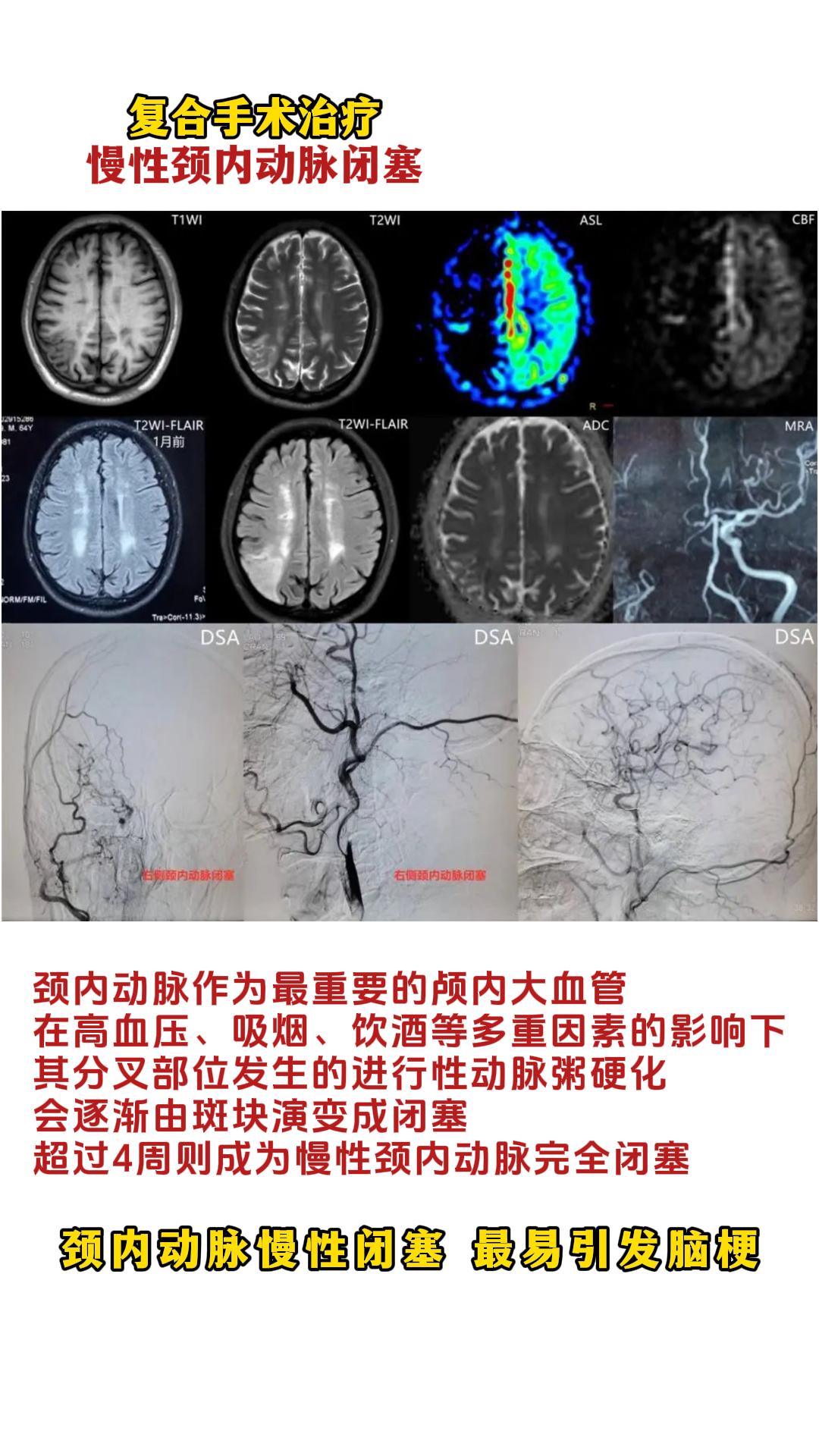 脑卒中是严重危害我国国民健康的重大慢性非传染性疾病，具有高致死率、高致...