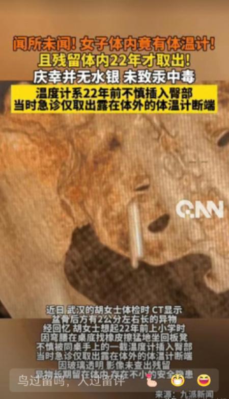 “彻底解释不清了！”湖北武汉，一女子参加体检时，意外发现盆骨里有奇怪异物，足足有