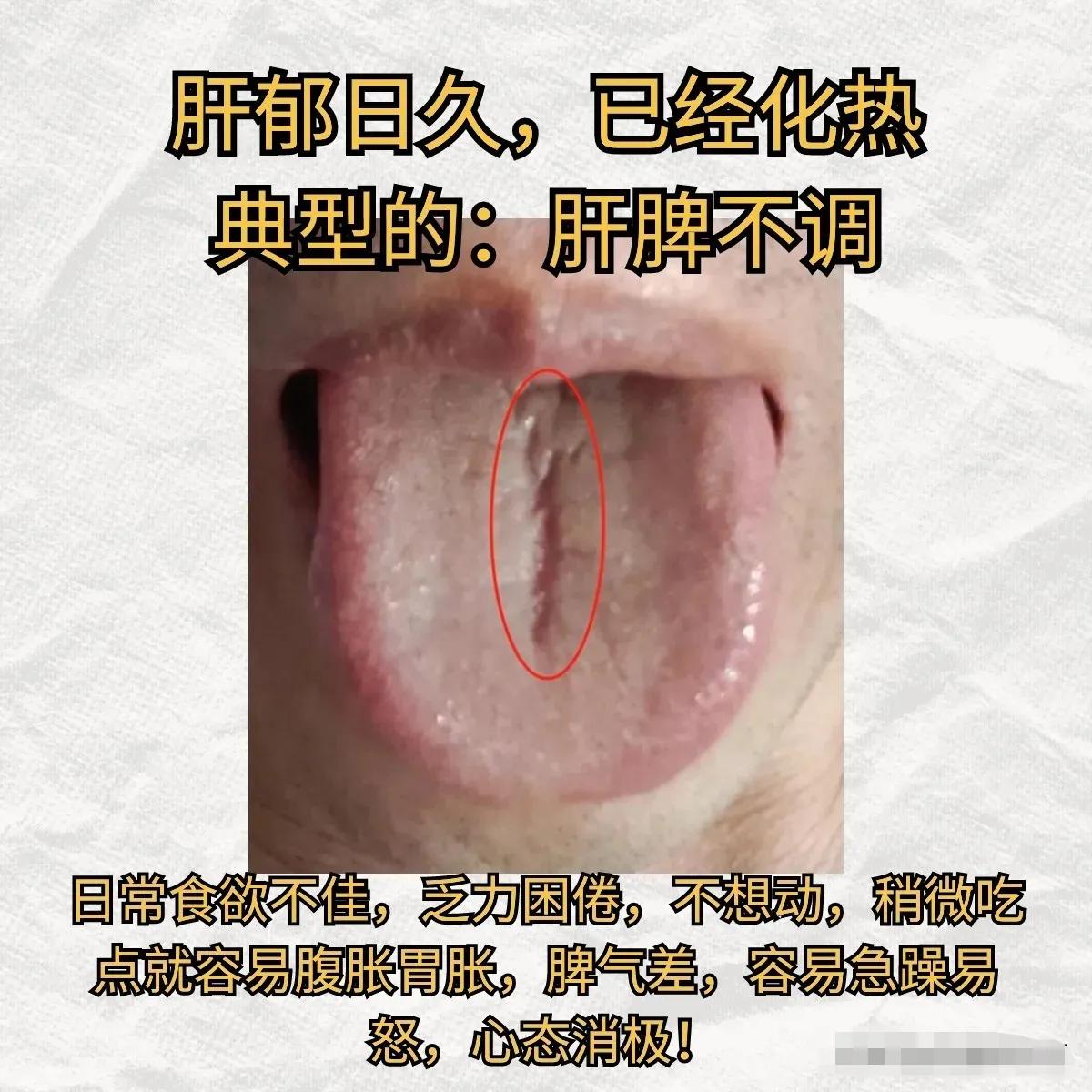 解读身体信号，从舌象看健康——肝郁化热、脾阳虚与气血两亏的调理之道。

今天，我
