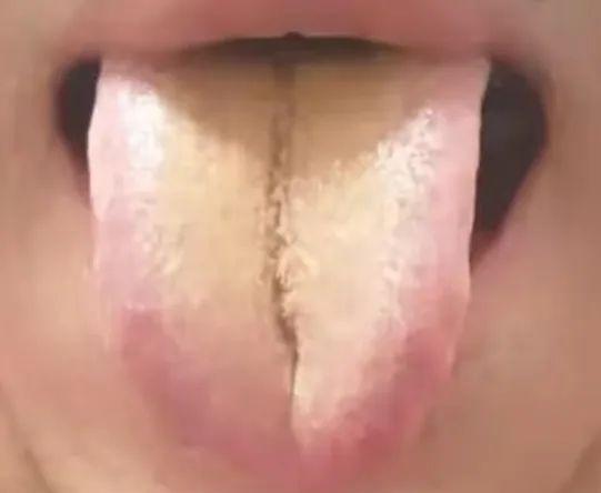 纹舌背后的故事：肝气郁结与脾胃不和
这条明显的裂纹并非脾胃的问题，它的根源在于肝