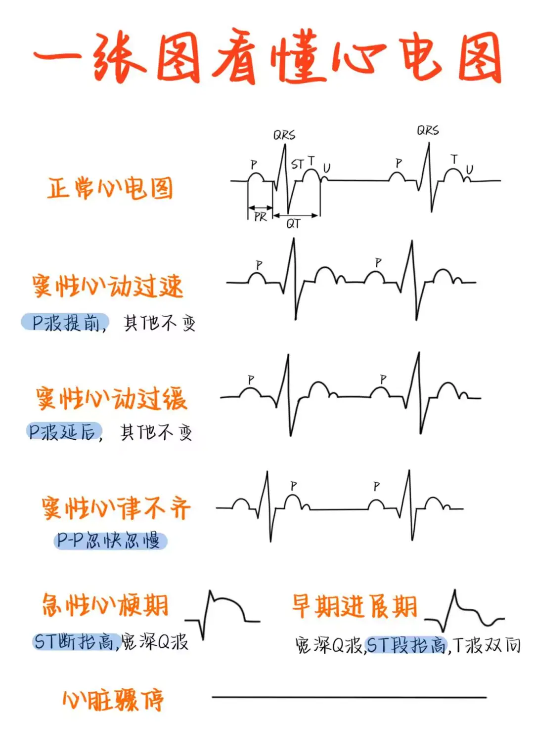 医学生笔记——一张图看懂心电图