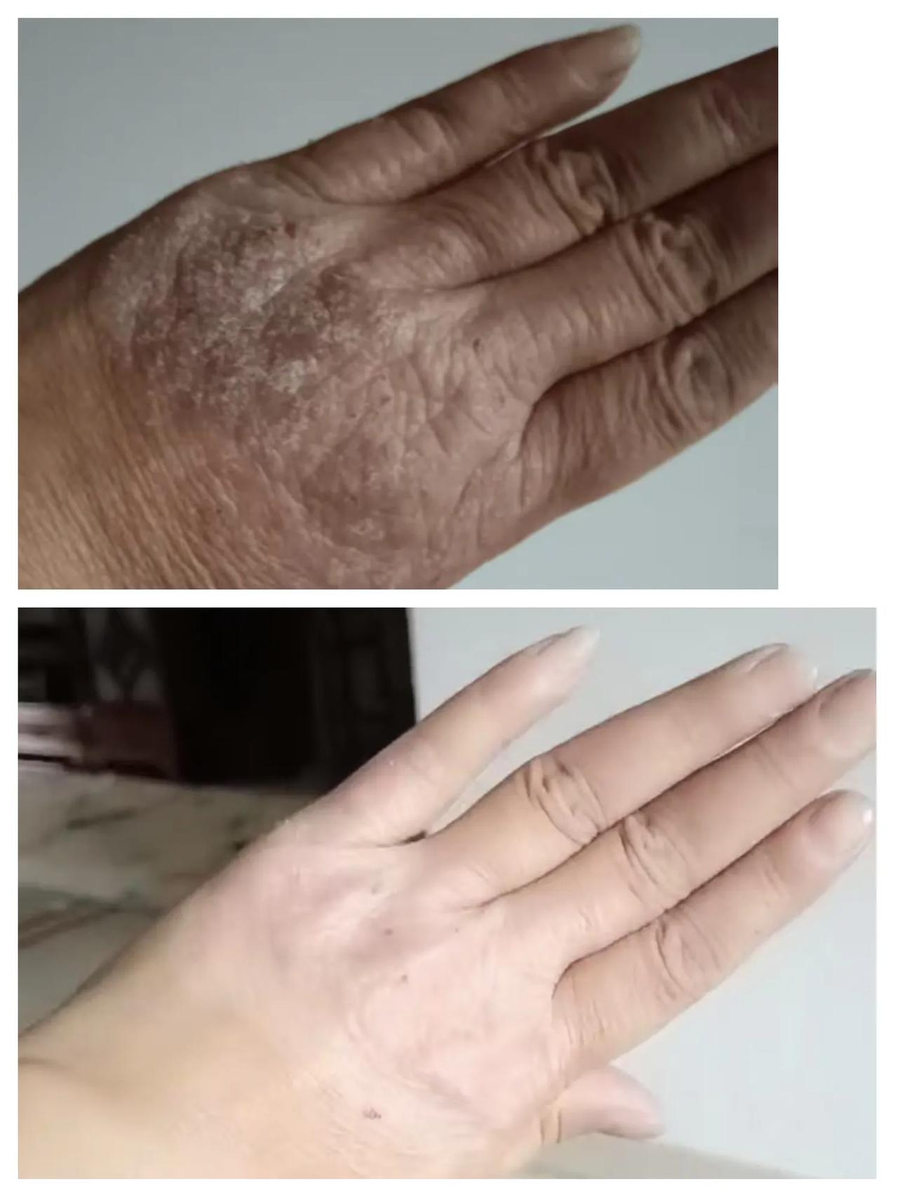 用了6天的效果，皮肤完好如初，终于解决多年的心病
