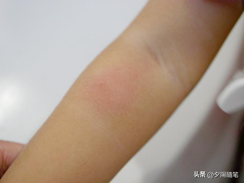 被虫咬后判断是否就医，先得初步判断是被啥虫咬了。像蚊子咬，一般是小红肿包，伴瘙痒