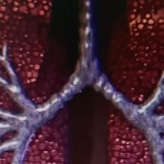 双肺纹理增多，简单说就是在胸片或者CT上，看到从肺门向周边呈树枝状分布的阴影比正