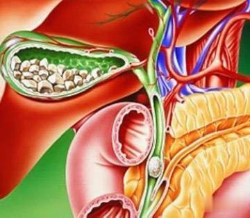十二指肠镜能解决部分胆囊结石是不是很神奇。各大医院都在尝试通过ERCP...