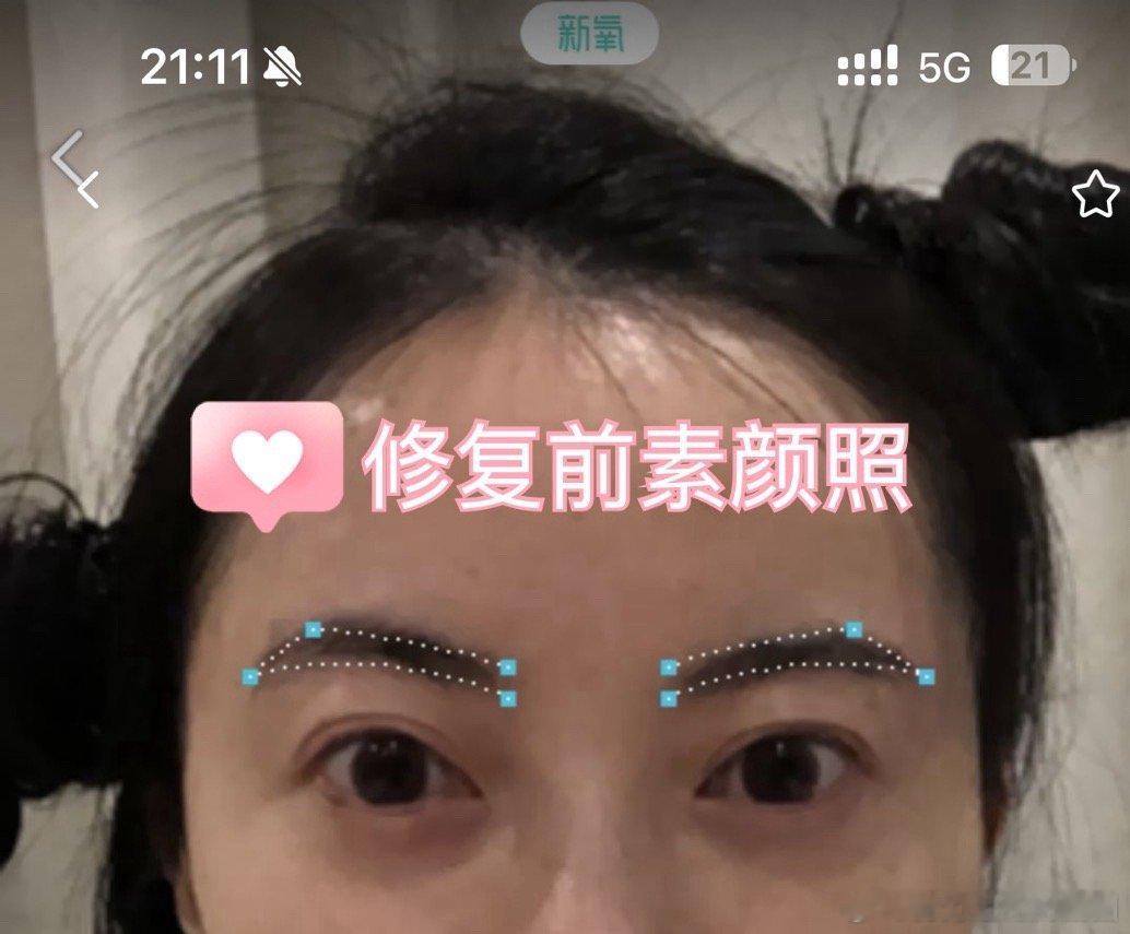 双眼皮修复功课。也是人生转运的开始……老粉都知道我2023年变化很大，单身了好多