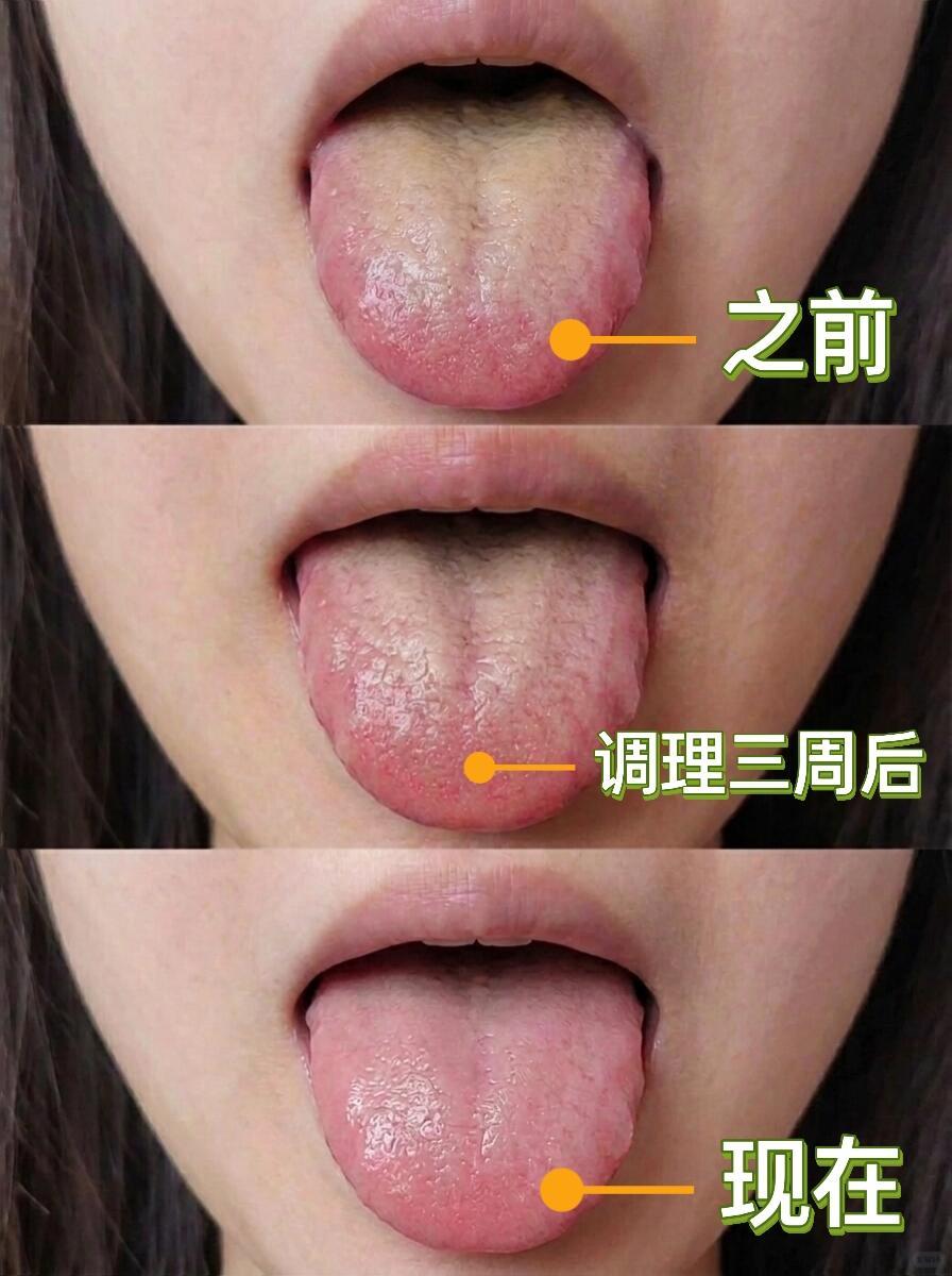 五周，我这样给她调的，厚腻舌苔消失！ 

第一阶段：清湿热（第1-2周） 

第
