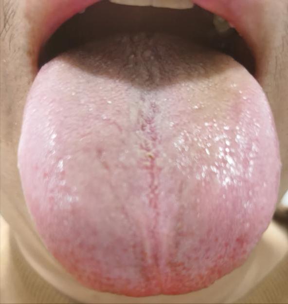 年纪轻轻，三十几岁，身体毛病不断，看这个舌象：身体被糟蹋的不轻
患者说，之前不节