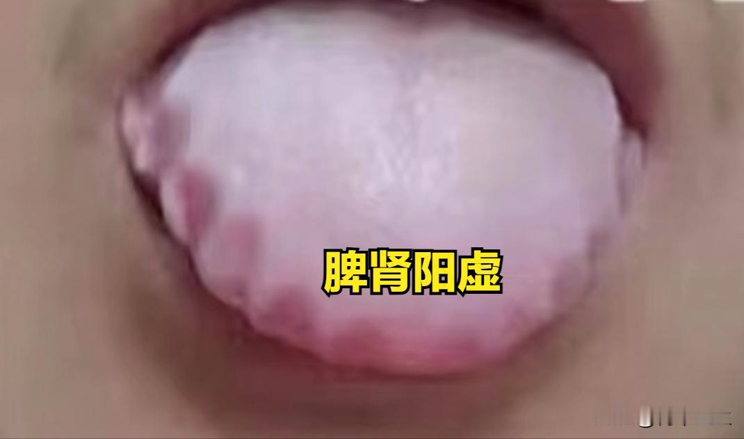 附子理中芄这样才算是用对了，三种情况，三种搭配，今天一次性讲清楚

1. 脾肾阳