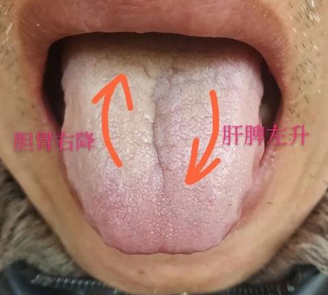 舌苔厚腻分左右，左侧厚是肝郁，右侧厚是胆胃气不降！今天一次讲清

1.左侧舌苔厚