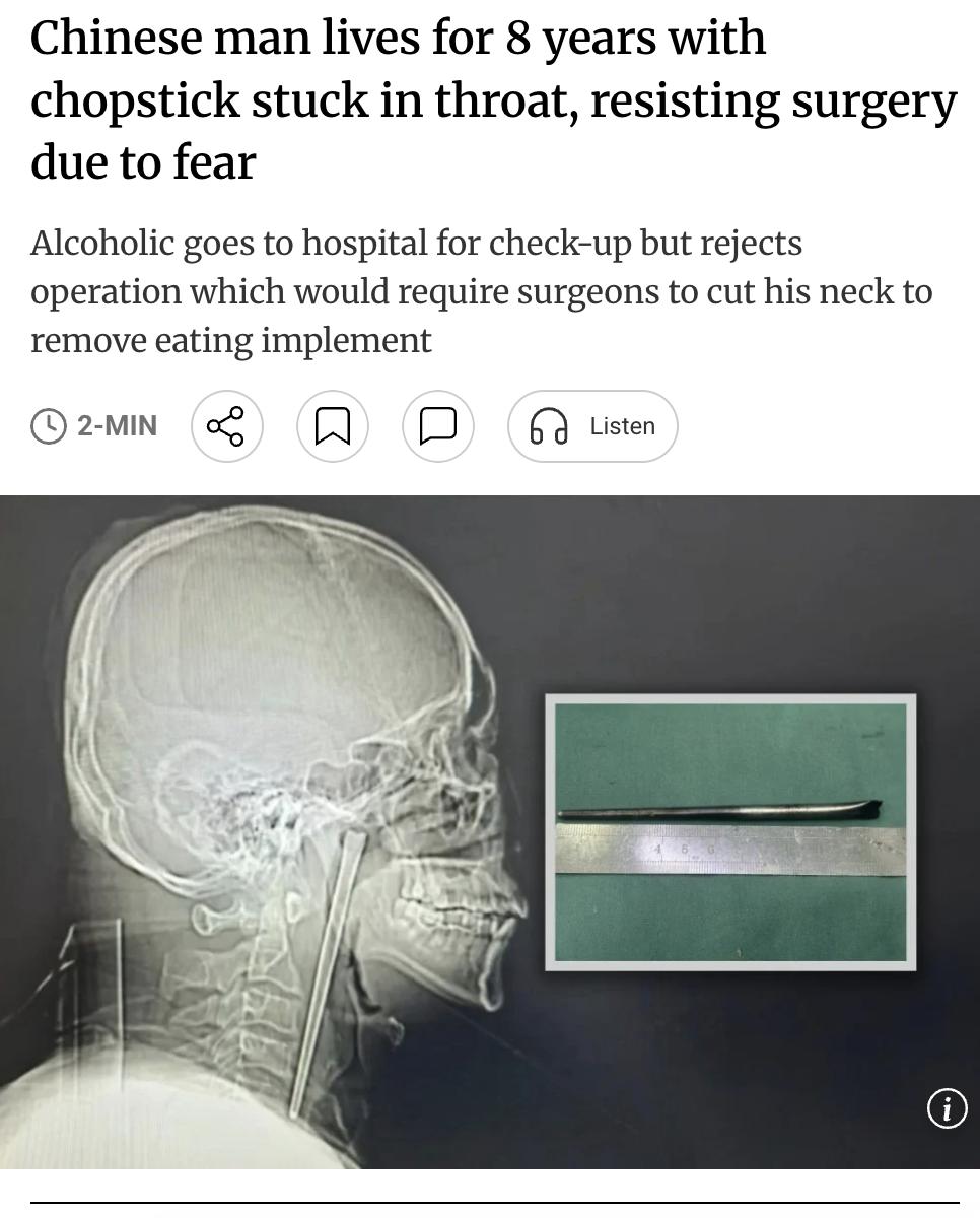 外媒：中国辽宁大连一名王姓男子八年前饮酒时误吞一根12厘米长的金属筷子，因害怕手