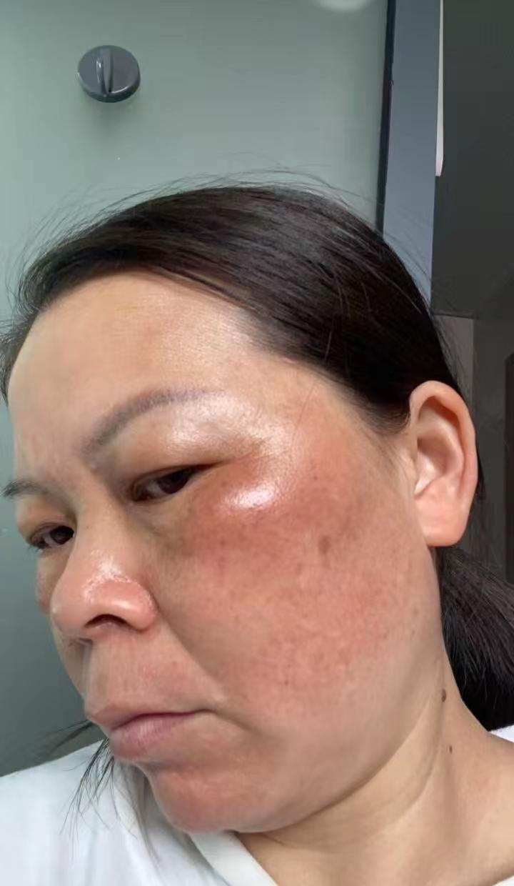 阿姨网购祛斑产品被骗，脸又烫又肿来找天悦。有位阿姨在网上买了祛斑产品，结果被骗了