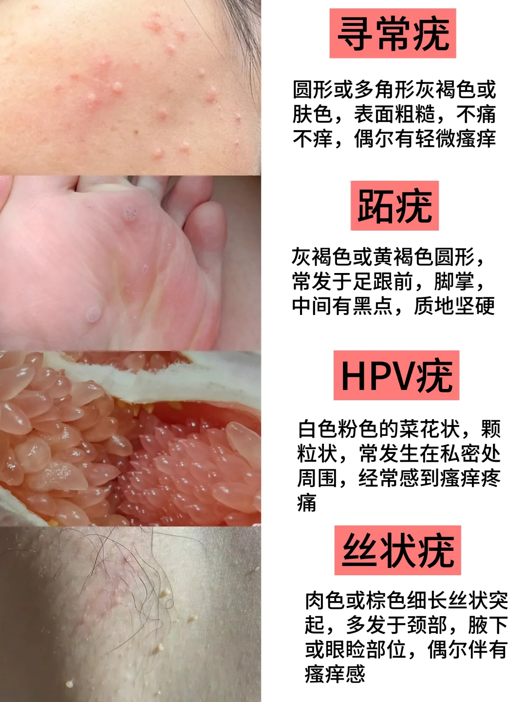 感染HPV怎么办❗HPV疣体简单一招就解决