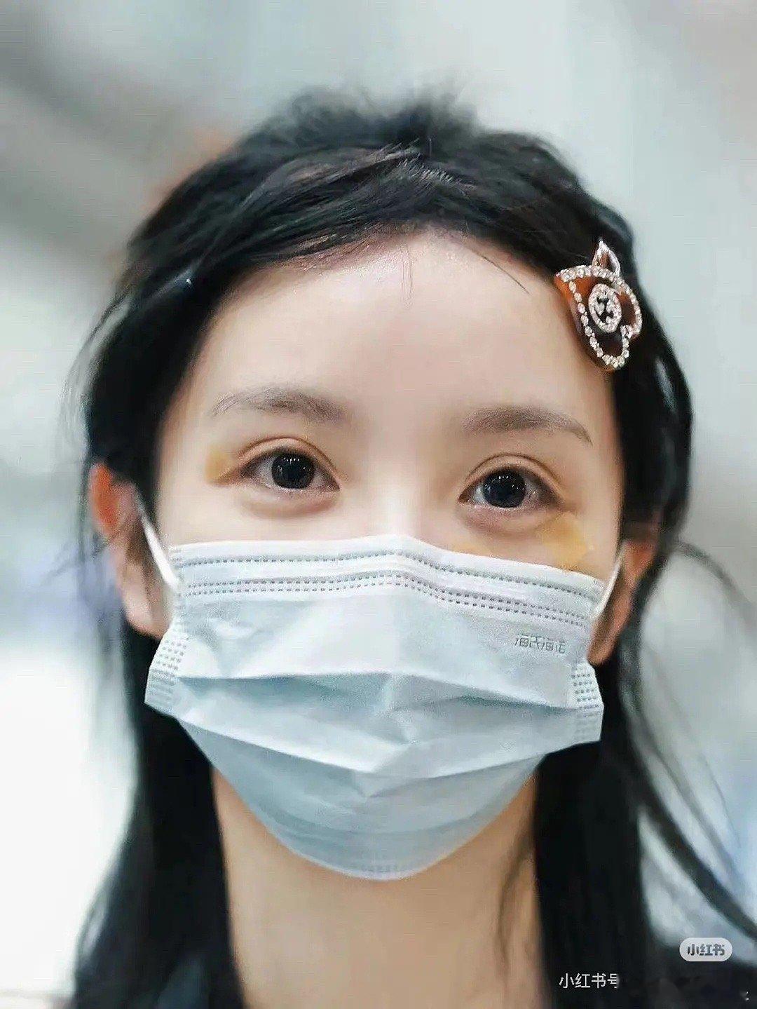 田曦薇这是肿了吗？可别步入🍵的后尘啊 ​​​