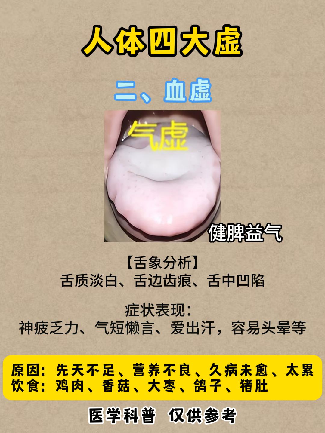 人体4大虚，气虚才懒，血虚才枯，阴虚才热，阳虚才冷！你有没有呢？

①阴虚
【舌