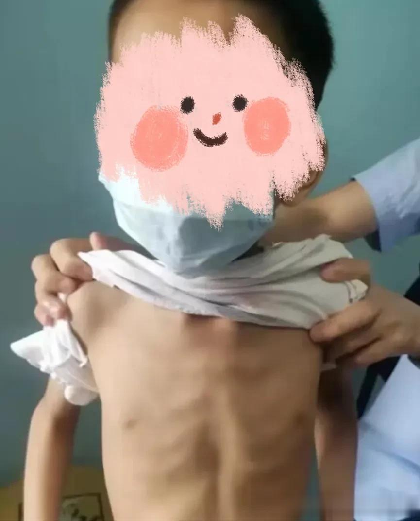 真实医案：心疼！6岁的男孩瘦的皮包骨了，体重还不到30斤，能吃不吸收不长个不长肉