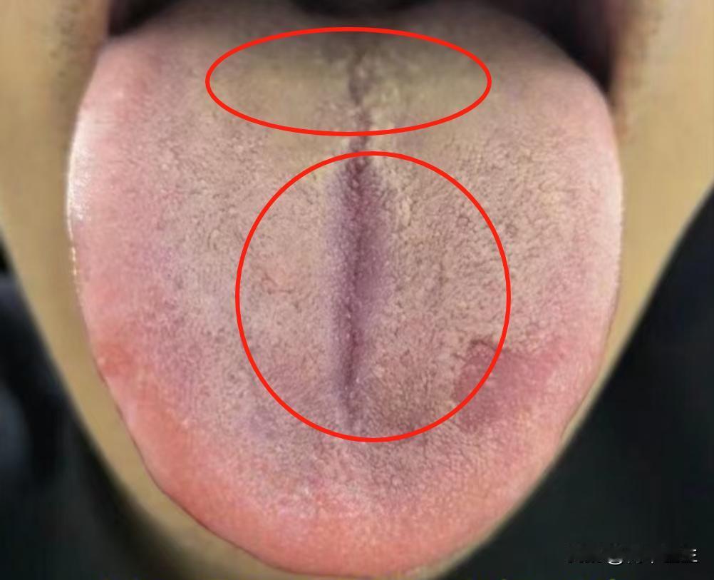舌头变这样，你不生病谁生病，实话说，最怕的就是在门诊上遇见这样的患者了
这位患者
